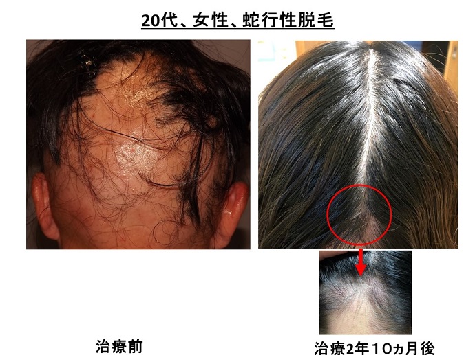 円形脱毛症　病院